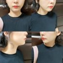 청담밴스의원 | 청담밴스의원 울쎄라 리프팅 300샷 가격/후기