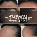 블랙라인 - 파주시 와석순환로515번길 61 | [공지] [대전 두피문신]M자 탈모 고민 해결! 도안동 "모어블랙" 헤어라인 1회차 리얼 후기