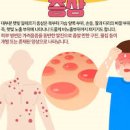 햇빛 알레르기 및 (재채기, 화상) 이미지