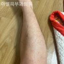 아벨피부과의원 네이버블로그