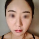 미라셀(주) | 유튜브 언니가 알려줄게 김현아원장의 실리프팅 잘하는 곳 신논현역피부과 에서 QT실리프팅 받은 후기