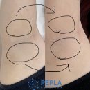 플라즈마교육 - 강남구 삼성로 341 | [대구 달서구] 피부관리 피플라 플라즈마 착색관리 후기｜겨드랑이 팔꿈치 색소침착 신부관리 예신관리