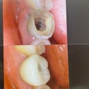 하나치과 - 광명시 안재로16번길 32 | 강남역치과 임플란트 내돈내산 후기｜겁 많은 저도 편하게 받은 어금니 임플란트