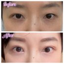 미드라인성형외과의원 | 피알성형외과 쌍커풀 눈매교정 재수술 내돈내산 후기👀 쌍수 재수술 후 한달 뒤 전후 비교‼️