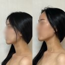 두경부화장 | 창원디예인피부샵 상남점 JH윤곽술 리프팅 관리 찐 후기