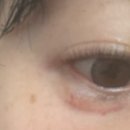 온도성형외과의원 | 온도 성형외과 애교살 반영구 내돈내산 후기