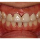 라미네이트비용 까맣게 변색된잇몸 라미네이트 치아성형치료.(라미네이트가격.앞니성형) 이미지