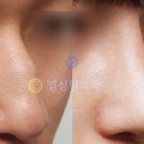 별성형외과 네이버블로그