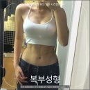 포레성형외과의원 | 복부성형후기 치골지방흡입 양보다 중요한건?