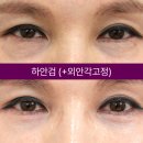 아이케이성형외과의원 네이버블로그