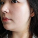 프라임21 | 울쎄라 프라임 일주일 후 붓기 유지기간까지 솔직 후기