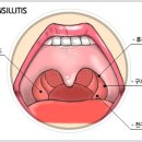 만성편도선염 치료비방 이미지