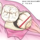 [난발치 사랑니 발치후기] 사랑니발치 리얼후기 / 사랑니발치 식사 / 사랑니발치 통증 / 사랑니발치...
