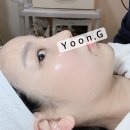 신사역365 약국 | 지페이스주사 투턱녀의 강남 조각주사 후기