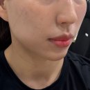 디자인온다 - 23609 | 여수학동피부과 턱선 V라인관리 온다리프팅후기 | 리쥬엘의원 페이스온다 5만줄 솔직후기
