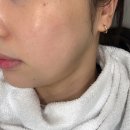 닥터쁘띠의원 | 건대 닥터쁘띠의원 온다리프팅 시술 후기