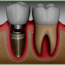 가정백세플란트치과의원 | 어린이 치과 마취 안전하게 진행되는 과정의 모든 것