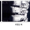 요추 퇴행성 디스크질환(Degenerative Disc Disease) 이미지