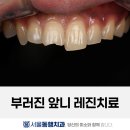 빛치과의원 | 넘어져서 부러진 앞니, 레진으로 치료한 케이스 | 대구 수성구 서울동행치과의원