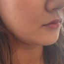 로사의원 | 강남 로사클리닉 소프웨이브 내돈내산 후기 가격 효과