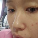 강남 피부과 플래뉴의원에서 피코토닝, 클리너코코 모공,블랙헤드 후기