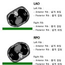 Rib series oblique [RAO=LPO, RPO=LAO] 이미지