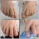 중앙동322 | 안산 레푸스 무좀발톱관리후기