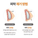 강남아름다운유외과의원 | 가슴 구형구축 시기, 등급별 진단 후 치료/재수술 방법