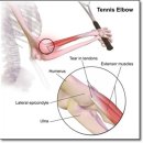 테니스 엘보우(Tennis Elbow / Lateral Epicondylitis)로 인한 팔꿈치 통증의 증상과 치료 방법!