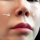 미희네 | 팔자주름 강남피부과 콜라겐주사 미희주사 후기