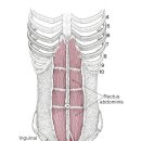 복직근의 근근막통증(MPS) 이미지