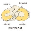 ﻿반월판 연골손상 (Tear of meniscus) 이미지