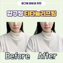 정메디칼 | 압구정 티타늄리프팅 유지기간 통증 효과 가격 키닥터 후기