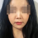 가슴연골 써서 수술한지 3개월 지났어! (비염수술+이마 지방이식도) 이미지