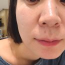 중봉로 | 쿨페이즈 600샷 통증없는 써마지 효과 김포해밝은의원 일주일 후기