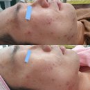 흉터관리잘하는 퓨어에스테틱 방문후기