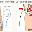 단순도뇨 & 유치도뇨관 (여자 남자 소변줄 삽입, 목적) 이미지