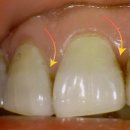 바른이웃치과의원 | 평촌역 치과 치아 사이 틈에 낀 노란 착색, 에어플로우(air-flow) 이용하여 치석 스케일링과 변색 제거까지