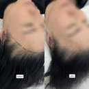 수정헤어라인 네이버블로그