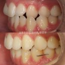 주걱턱과 비대칭의 양악수술 교정치료 [부산교정치과]