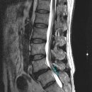 S안마시술소 | 감사합니다~강남 우리들병원 수술치료후기 / 척추전방전위증 인대재건술의 적용 / 이상호