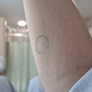 기쁨병원 | 담낭절제술 후기 - 2 (기쁨병원 로봇 수술)