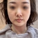 400 | 울쎄라 프라임 후 붓기 기간 400샷 일주일차 후기