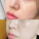 미희네 | 강남피부과 콜라겐주사, 눈밑 앞볼 미희주사 솔직후기 효과 사진