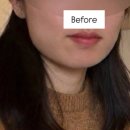 해피닥터의원 | 사각턱보톡스 두 달 변화: 볼패임 부작용 후기 (절망편)