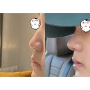 가족머리깎기 | Ep.2 | 복코+매부리+기능코 (비염) 무보형물 코수술 후 일주일