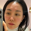 시크릿 | 피부과 모공 관리 시술 시크릿레이저 후기(효과, 통증, 부작용, 가격)