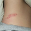 이화사랑피부과의원 | 관악구 동작구 일반진료 피부과 '이화 사랑 피부과 의원' 대상포진 진료 후기