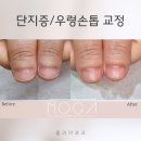 노가네일&속눈썹 | 손톱이 짧고 넓게 자라요 – 단지증 교정 과정 리뷰 -광주 노가인증샵 손톱 교정 엄지 단지증 우렁네일