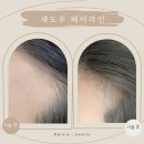 그레이스뷰티레슨 | 울산 송정동 그레이스뷰티 smp 두피헤어라인 커버 탈모가 고민일때 , 울산 smp 솔직후기